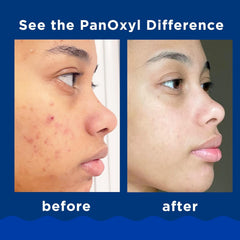 PanOxyl Acne Foaming Wash Benzoyl Peroxide 10% Maximum Strength Antimicrobial, 5.5 Oz